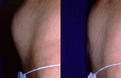 liposuction-before-after-tumescent.jpg