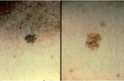 27+ Malignant Melanoma Mole Pictures