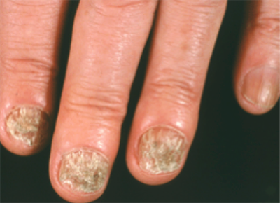 nails-with-ringworm-infection-1.png
