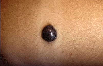 melanoma-14-year-old-girl-arm.jpg