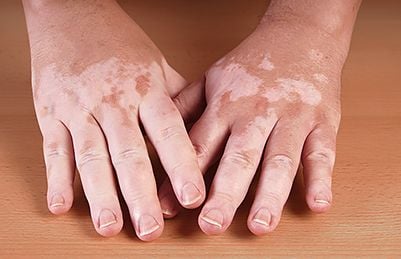 melanoma-skin-reactions-targeted-therapy-vitiligo.jpg