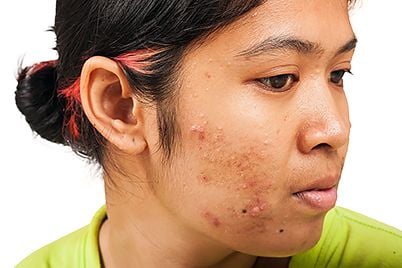 acne-how-long-take-antibiotic.jpg