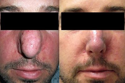rosace-treatment-thick-skin-before-after.jpg