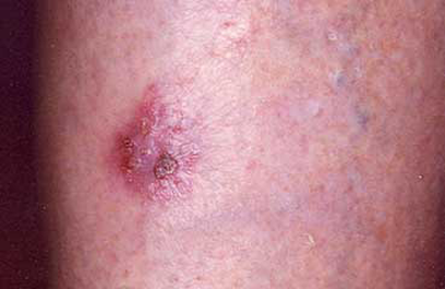 Stasis-dermatitis_symptoms-sore_leg.png