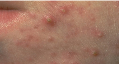 acne papules and pustules