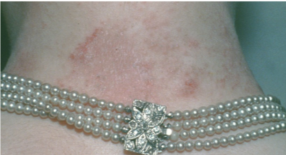 Allergic contact dermatitis to nickel sulfate
