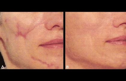 lightning scars and dark spot removal