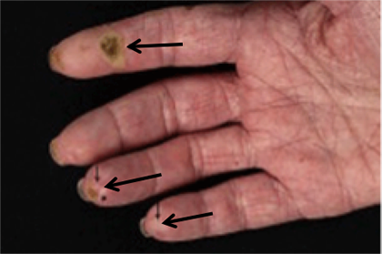 Limited-cutaneous-scleroderma.png
