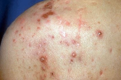Acne popping severe Newsflare