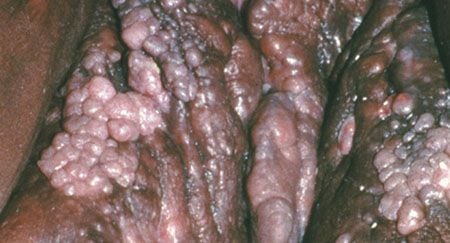 papilloma genital