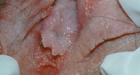 hpv warts itchy)