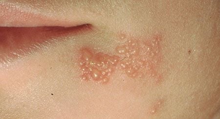 Can a person with hsv 1 give their partner herpes?