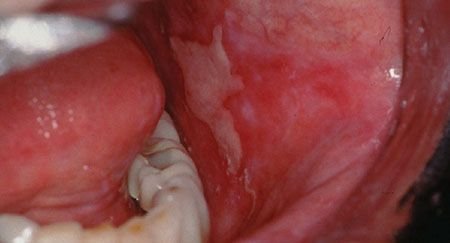 oral lichen planus cheek