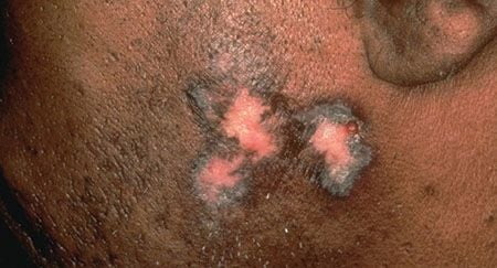 Lupus And Your Skin Framingham Dermatology Framingham Ma