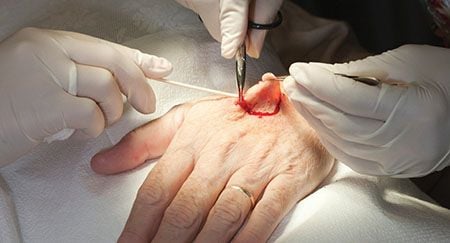 Mohs Surgery on the hand