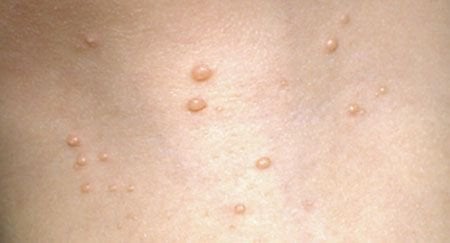 Molluscum Contagiosum - Dermatologist in Santa Rosa, CA | NorCal ...