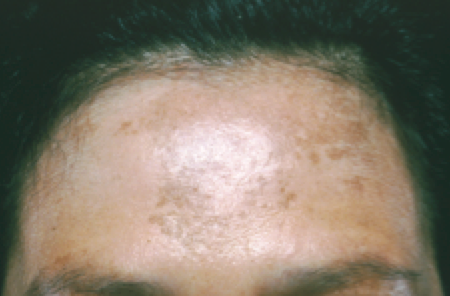 melasma_forehead.png