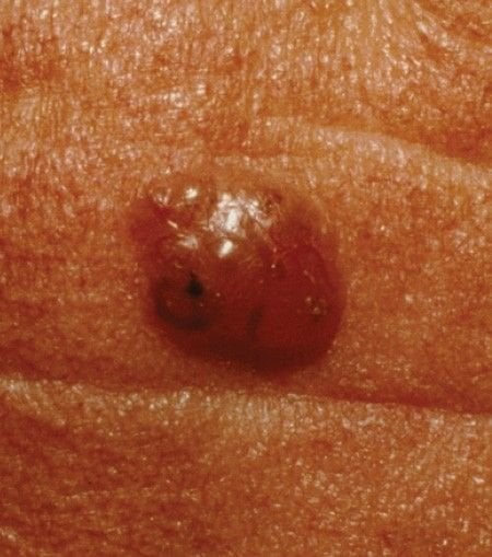 Basal cell carcinoma