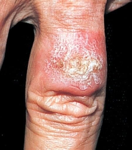 Squamous cell carcinoma