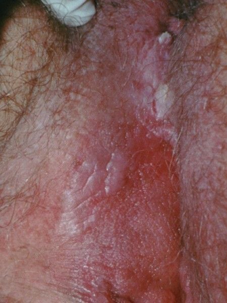 hpv genital bumps