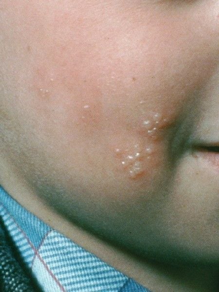 Herpes razor bumps