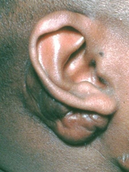 Keloid behind the ear