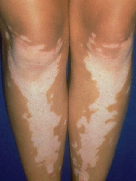 Vitiligo on the legs