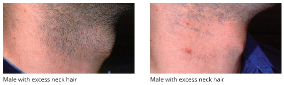 Laser Hair Reduction | Dermatologist In Omaha, NE | Center of Dermatology,  .
