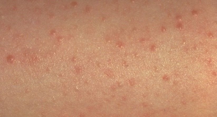 keratosis pilaris dry dermatology dermatologist