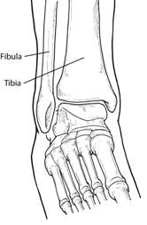 foot and ankle fracture in Philadelphia and Huntingdon Valley, PA 