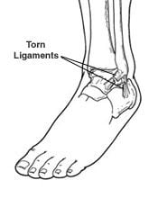 torn ligament diagram 