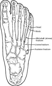 metatarsal fracture