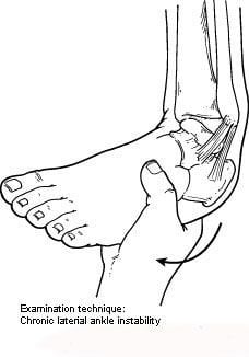 Ankle Instability – Diagnosis and Management of Acute and Chronic