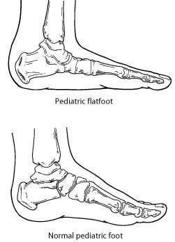 The Power of Pediatric Flexible Flatfoot Procedures