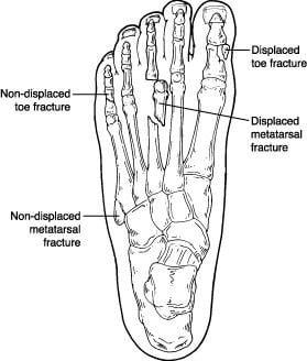 Metatarsalis arthrosis kezelés részletes leírása, Lábfej fájdalom áttekintés