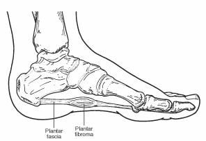 Fibroma2