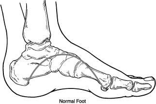 Foot Drop- Does It Go Away? - Well Heeled Podiatry