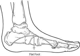 Flatfoot