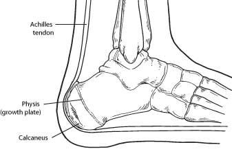 Calcaneal Apophysitis (Sever's Disease 