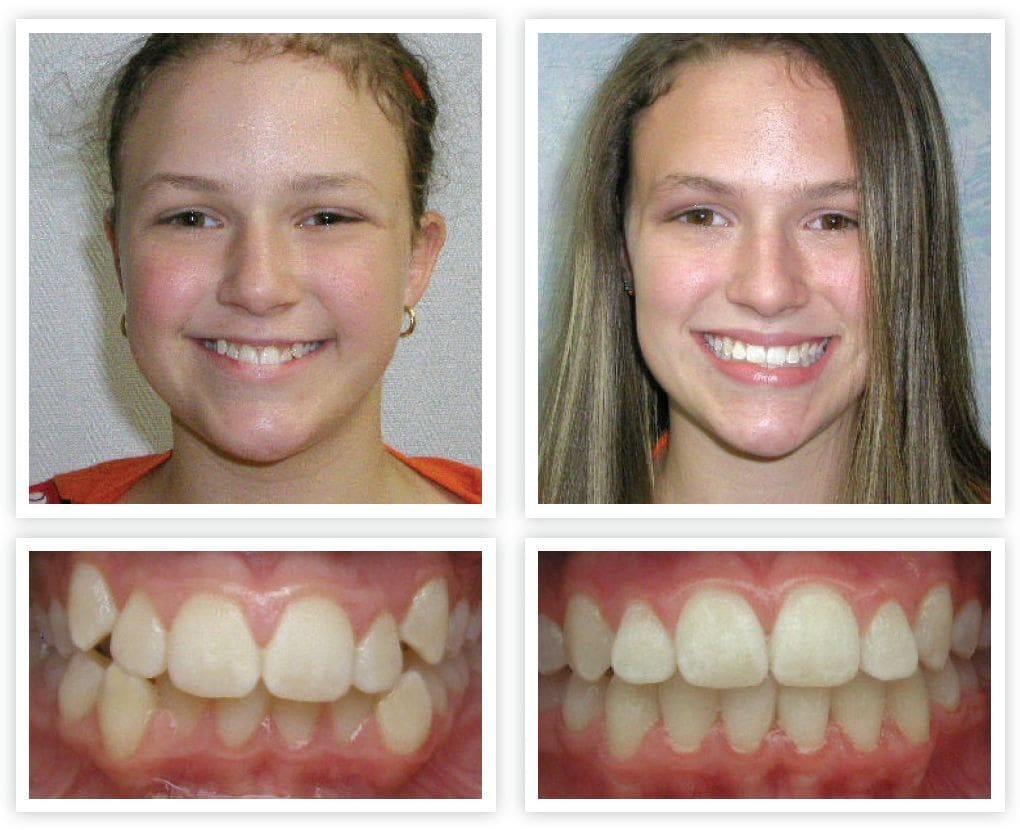 Before and after orthodontic treatment 
