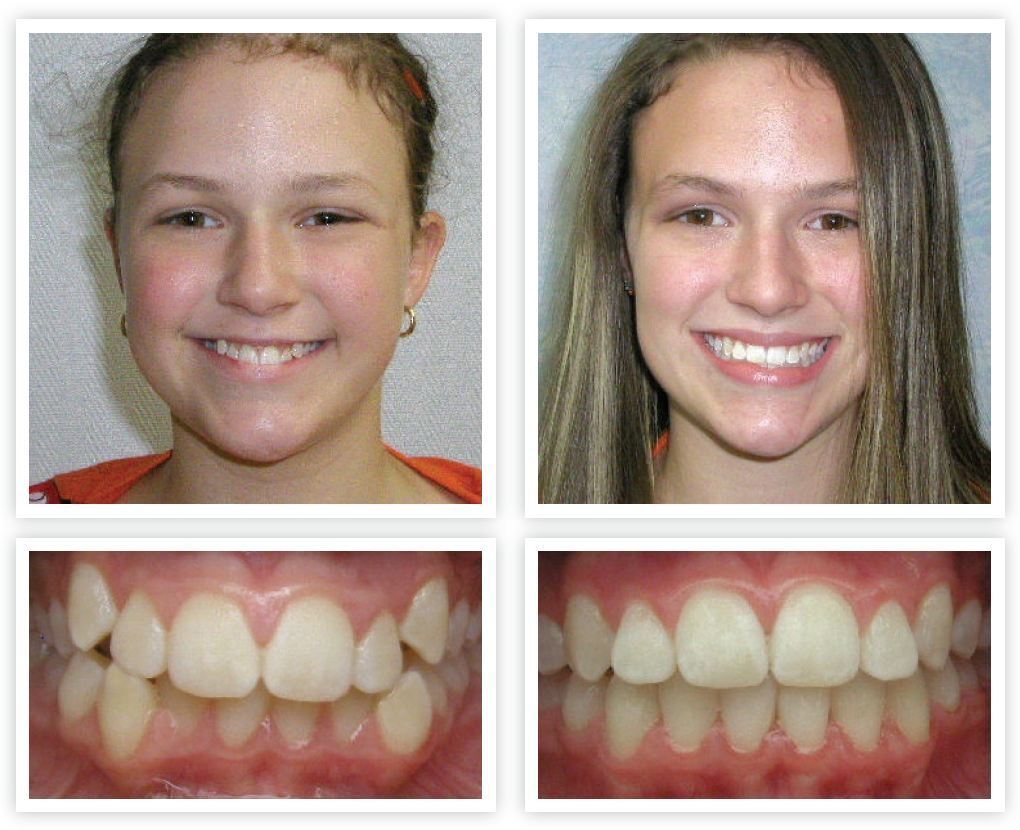 Orthodontic Treatment Roanoke, VA Dentist