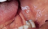 Leukoplakia