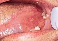 white spots inside lips