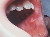 canker sore on cheek near wisdom tooth