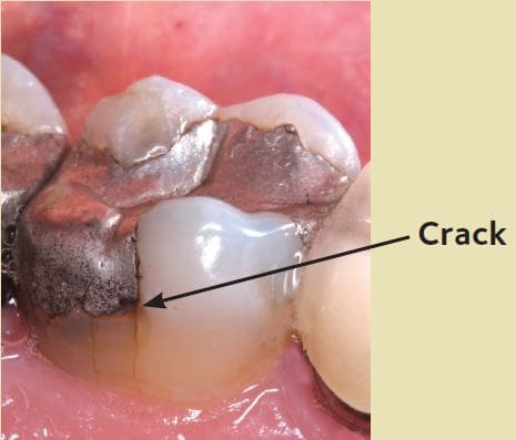 Cracked tooth with filling