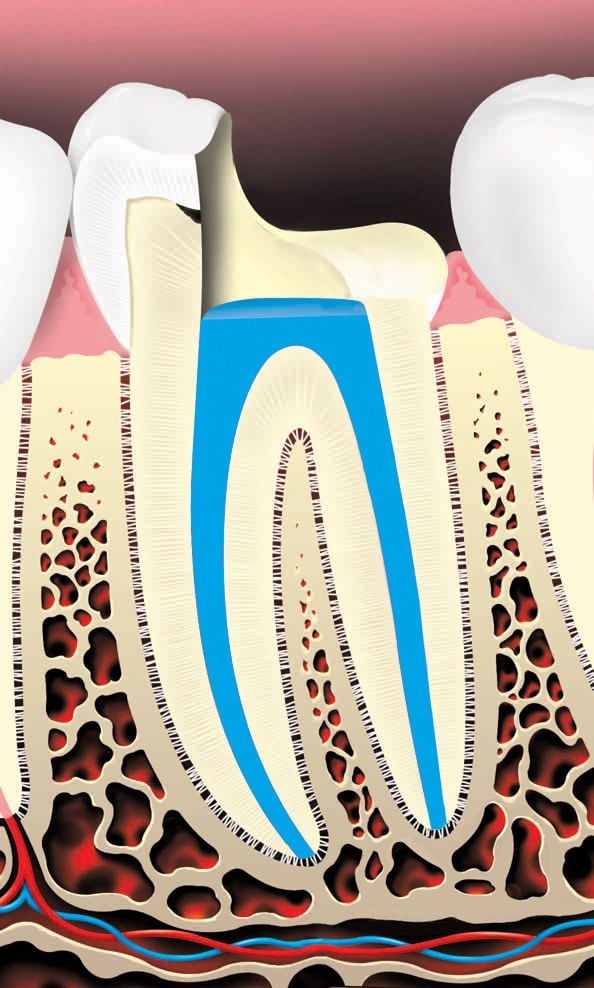 Root canal 4