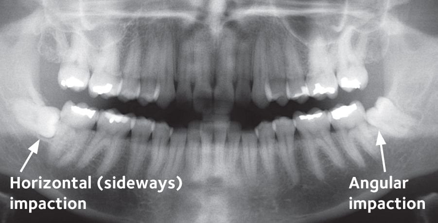 impacted wisdom teeth panoramic