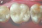 CEREC crowns