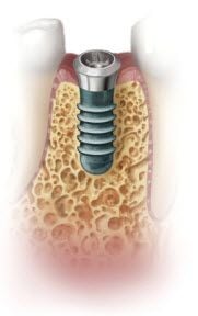 Straumann-implant-dental-single.jpg