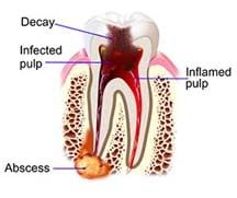 Decaying tooth